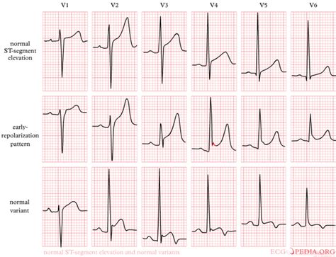 st elev probable normal early repol pattern.